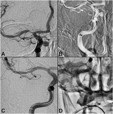 Utilization of the Ballast Long Guiding Sheath for Neuroendovascular Procedures: Institutional Experience in 68 Cases